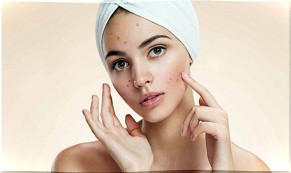 Beauty secrets against acne