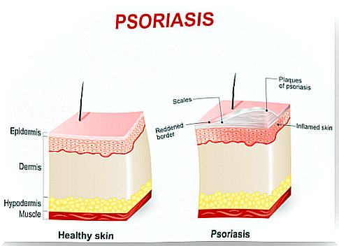 Acitretin can treat skin conditions such as psoriasis