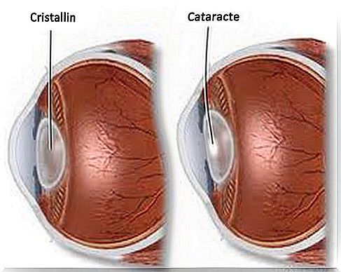 Profile view of an eye with cataracts.