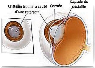 It is important to fight against cataracts.