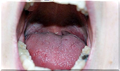 Canker sore in the mouth.