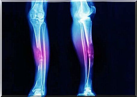 X-ray of the lower limbs. 