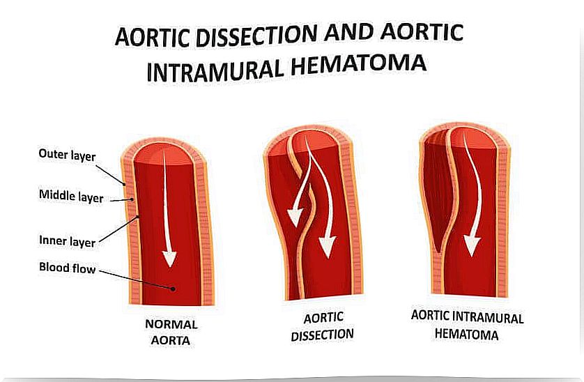 diagram of aortic dissection